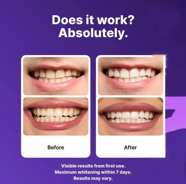 Purple teeth whitening strips results graphic